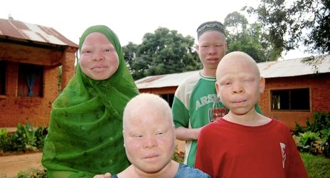 pomoc albinoskim dzieciom z Tanzanii